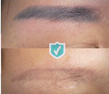 Laser 2 – Liệu Trình 3 Lần